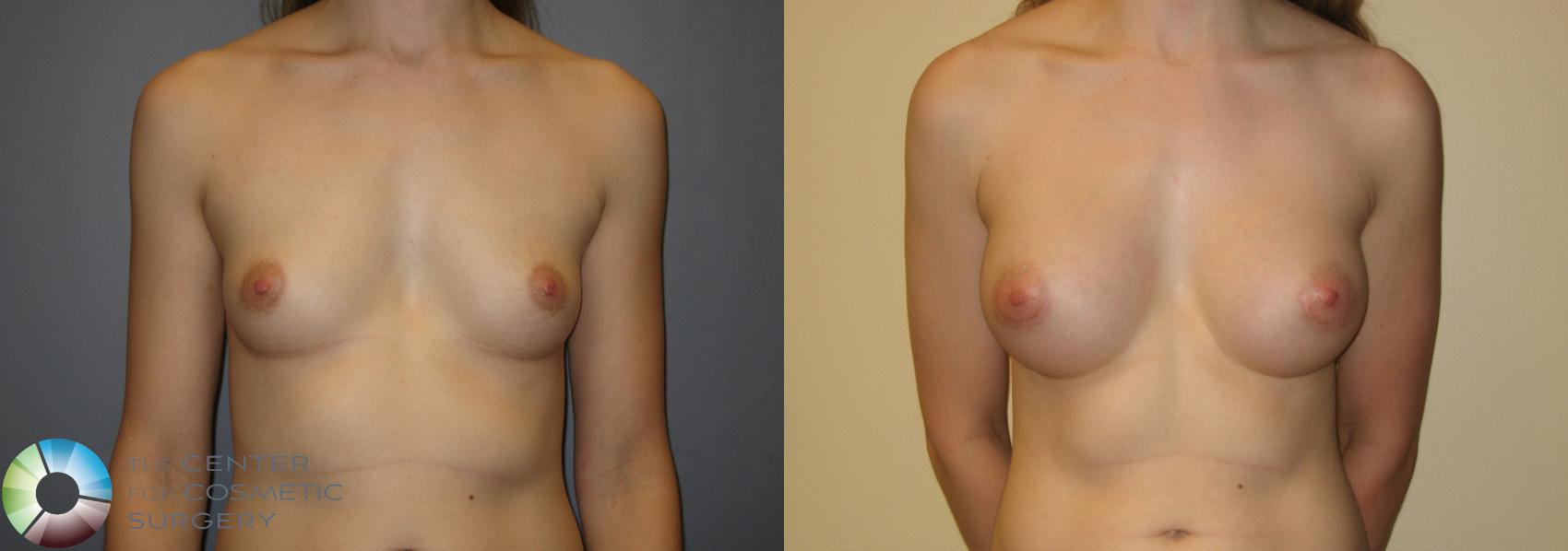 Before & After Breast Augmentation Case 210 View #2 in Denver and Colorado Springs, CO