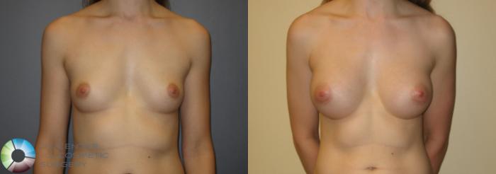 Before & After Breast Augmentation Case 210 View #2 in Denver and Colorado Springs, CO