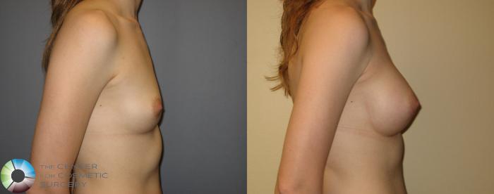 Before & After Breast Augmentation Case 210 View #3 in Denver and Colorado Springs, CO