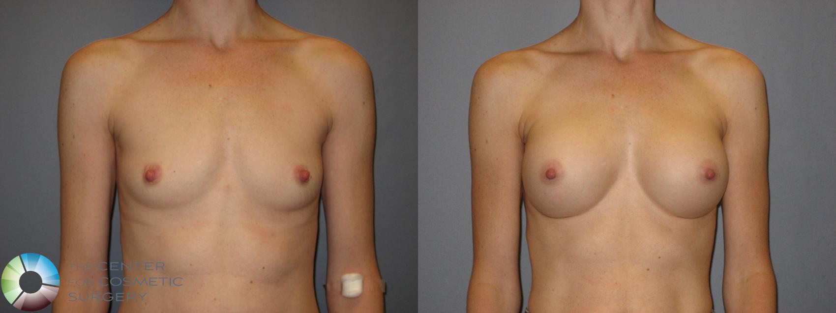 Before & After Breast Augmentation Case 213 View #1 View in Golden, CO