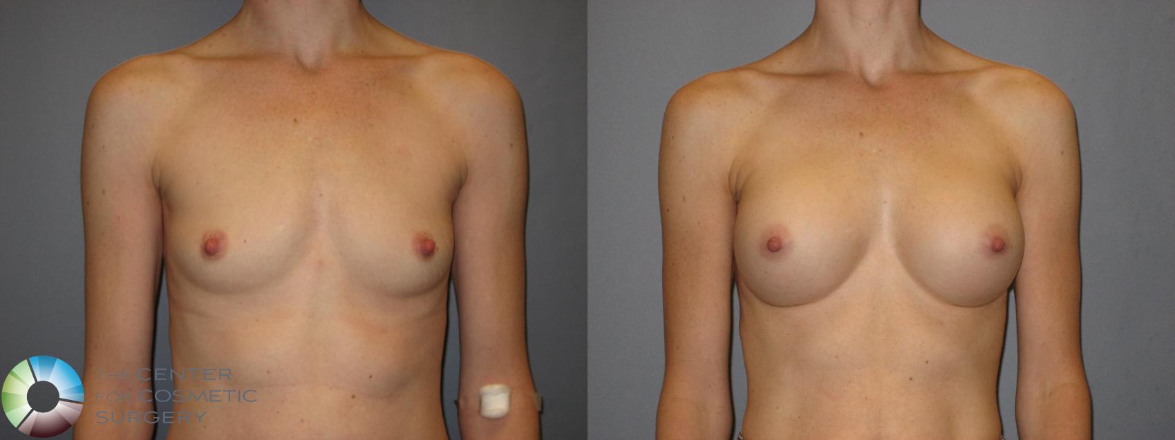 Before & After Breast Augmentation Case 213 View #1 in Denver and Colorado Springs, CO