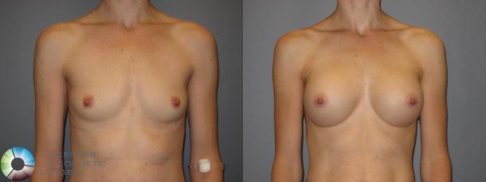 Before & After Breast Augmentation Case 213 View #1 View in Golden, CO
