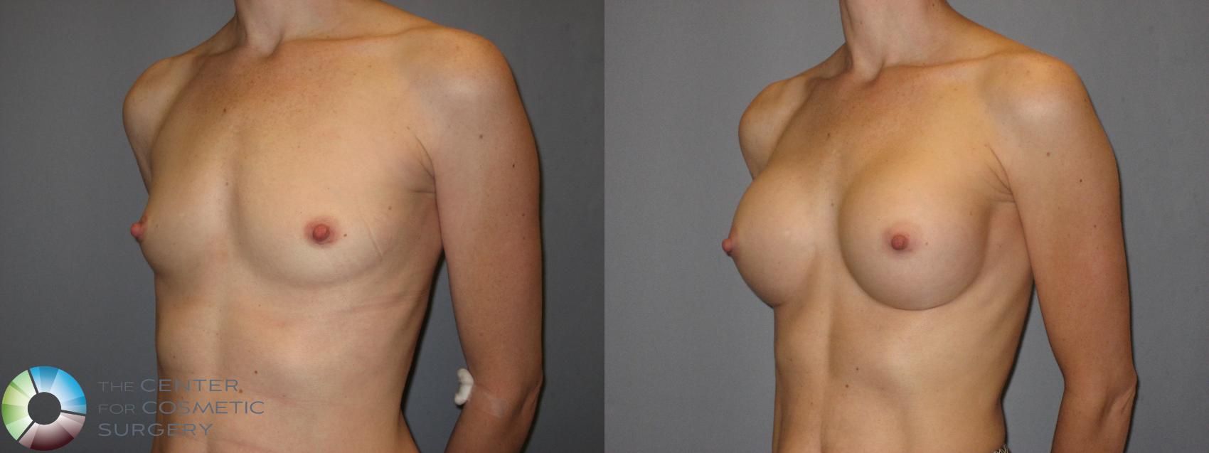 Before & After Breast Augmentation Case 213 View #2 View in Golden, CO