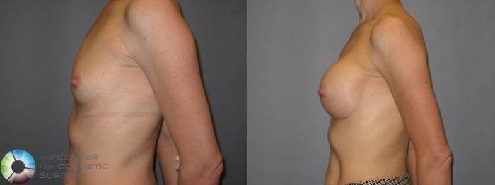 Before & After Breast Augmentation Case 213 View #3 View in Golden, CO