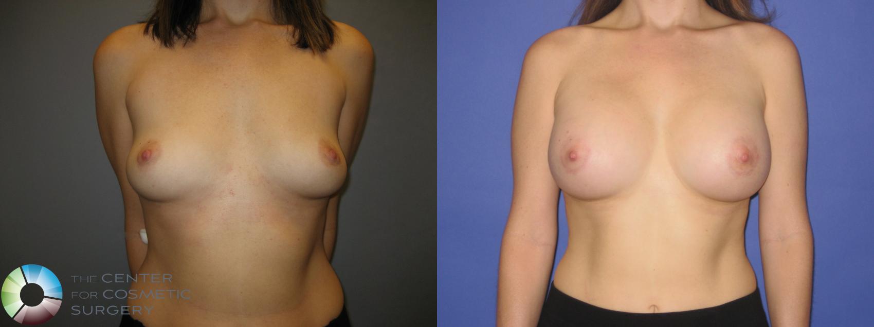 Before & After Breast Augmentation Case 218 View #1 in Denver and Colorado Springs, CO