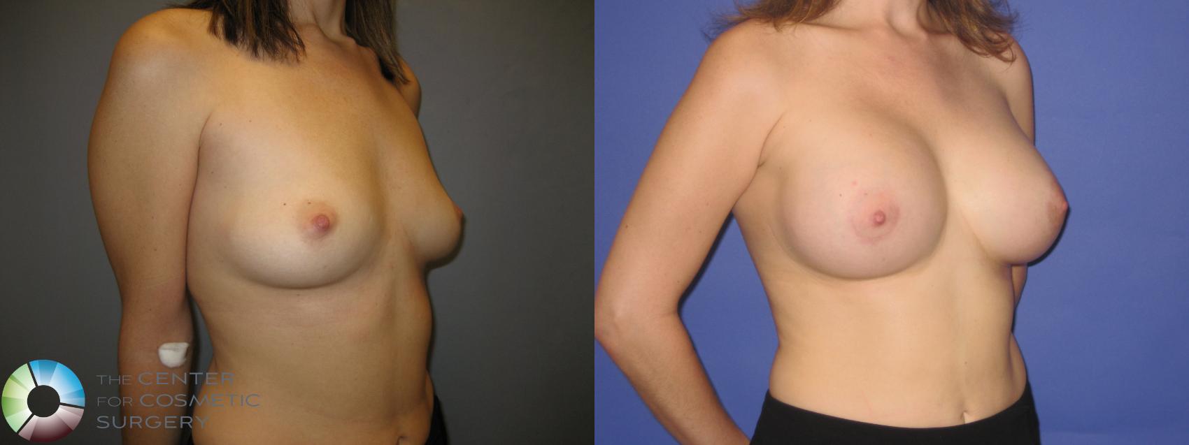 Before & After Breast Augmentation Case 218 View #2 in Denver and Colorado Springs, CO