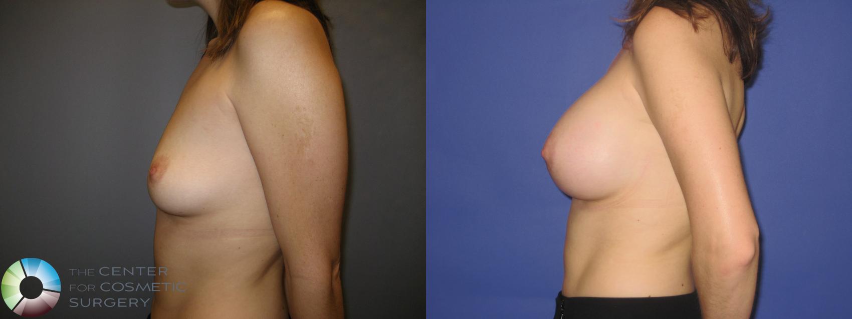 Before & After Breast Augmentation Case 218 View #3 in Denver and Colorado Springs, CO