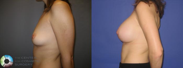 Before & After Breast Augmentation Case 218 View #3 View in Golden, CO