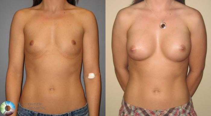 Before & After Breast Augmentation Case 219 View #1 in Denver and Colorado Springs, CO