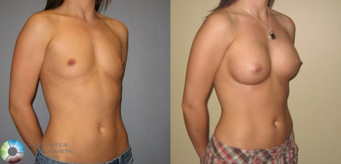 Before & After Breast Augmentation Case 219 View #2 in Denver and Colorado Springs, CO