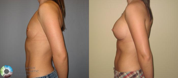 Before & After Breast Augmentation Case 219 View #3 in Denver and Colorado Springs, CO