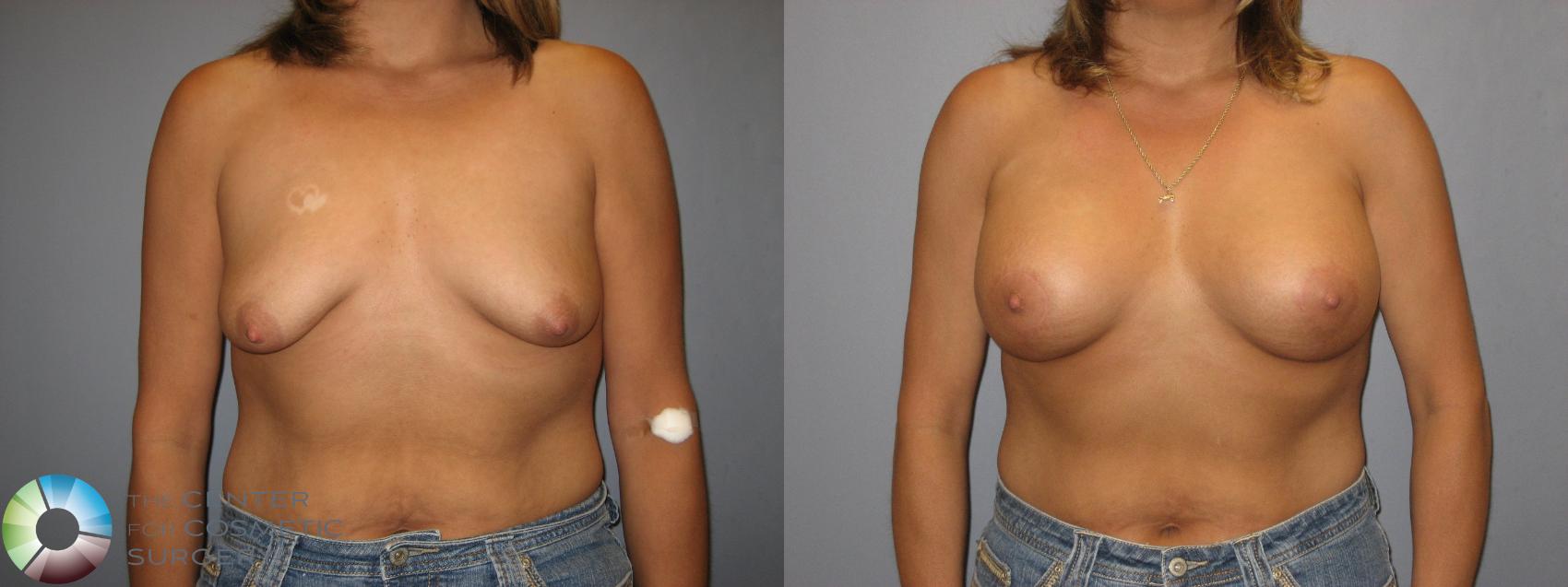 Before & After Breast Lift Case 222 View #1 in Denver and Colorado Springs, CO