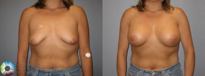Before & After Breast Augmentation Case 222 View #1 View in Golden, CO