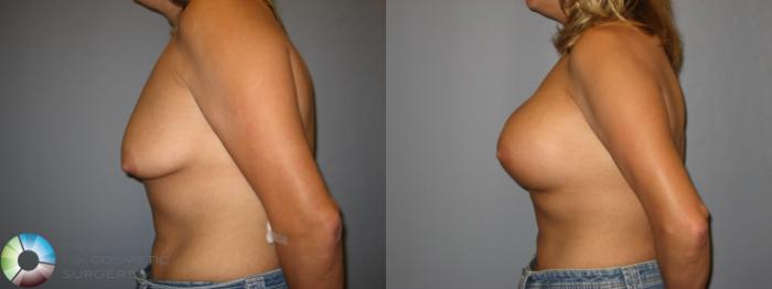 Before & After Breast Augmentation Case 222 View #2 View in Golden, CO