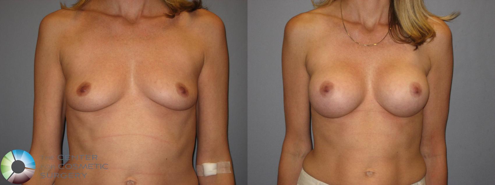 Before & After Breast Augmentation Case 223 View #1 in Denver and Colorado Springs, CO