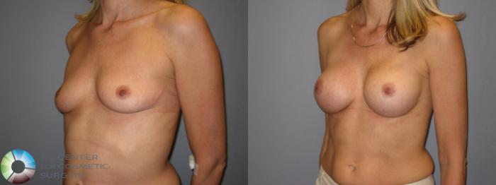 Before & After Breast Augmentation Case 223 View #2 View in Golden, CO