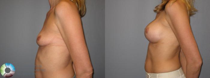 Before & After Breast Augmentation Case 223 View #3 View in Golden, CO