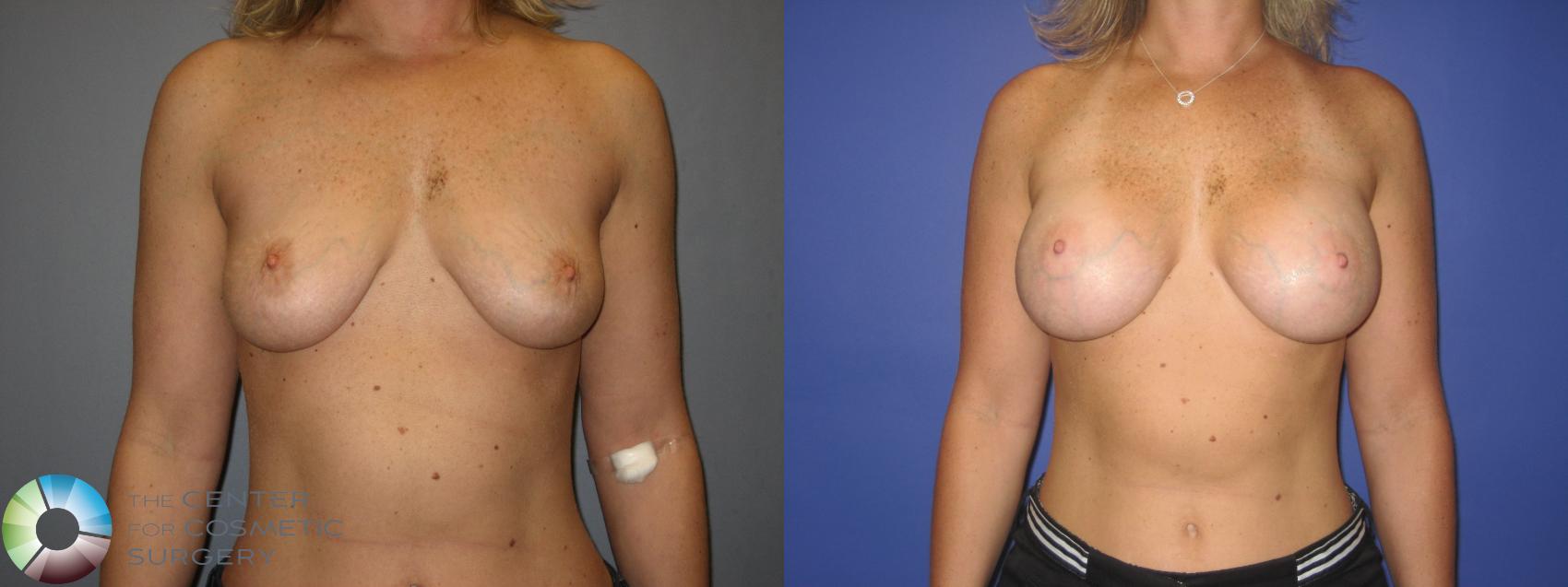 Before & After Breast Augmentation Case 224 View #1 in Denver and Colorado Springs, CO