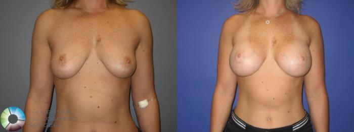 Before & After Breast Augmentation Case 224 View #1 View in Golden, CO