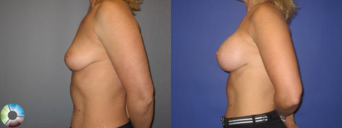 Before & After Breast Augmentation Case 224 View #3 View in Golden, CO