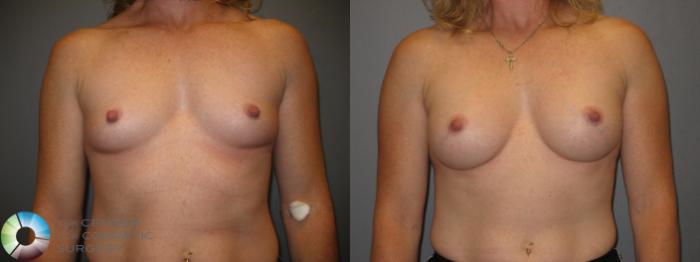Before & After Breast Augmentation Case 230 View #1 View in Golden, CO