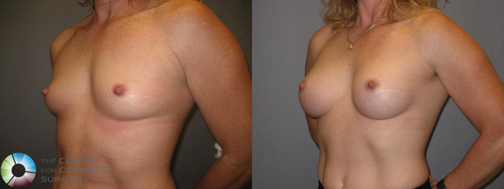 Before & After Breast Augmentation Case 230 View #2 in Denver and Colorado Springs, CO