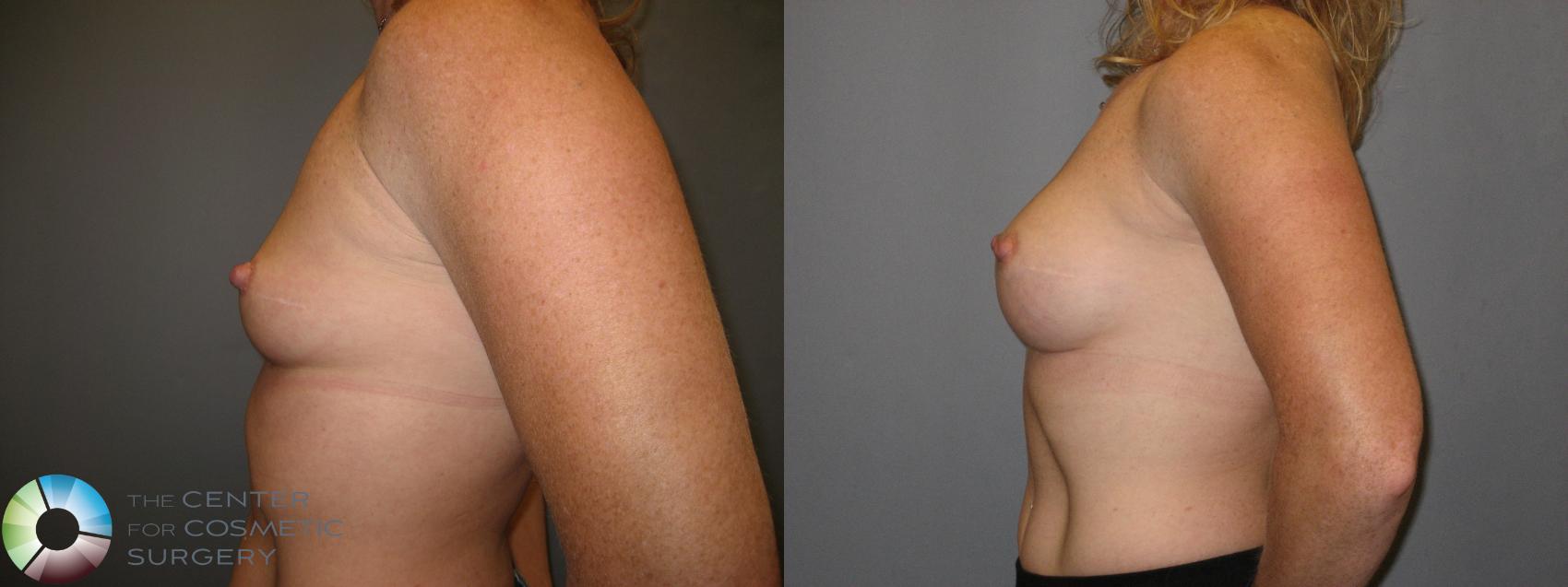 Before & After Breast Augmentation Case 230 View #3 in Denver and Colorado Springs, CO