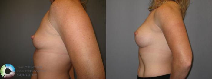 Before & After Breast Augmentation Case 230 View #3 View in Golden, CO