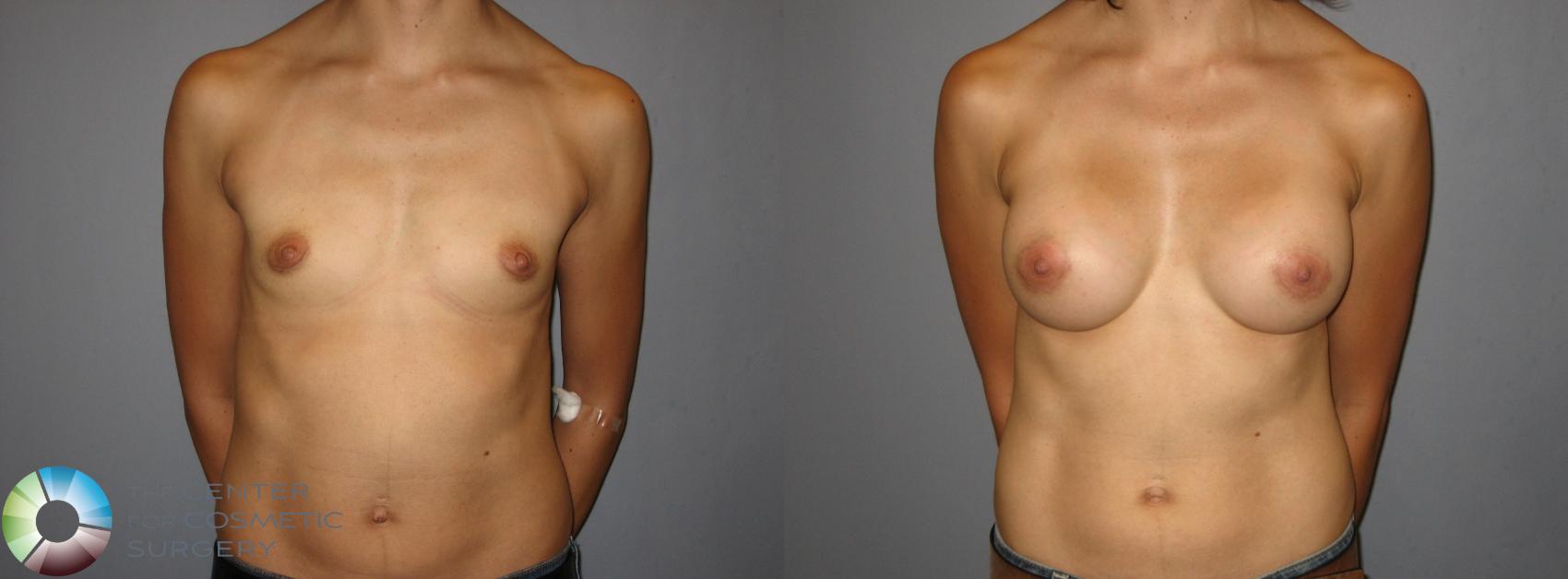 Before & After Breast Augmentation Case 241 View #1 in Denver and Colorado Springs, CO