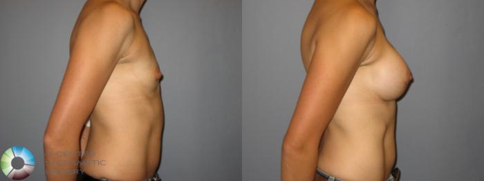 Before & After Breast Augmentation Case 241 View #2 in Denver and Colorado Springs, CO