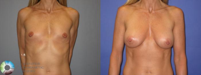 Before & After Breast Augmentation Case 242 View #1 View in Golden, CO