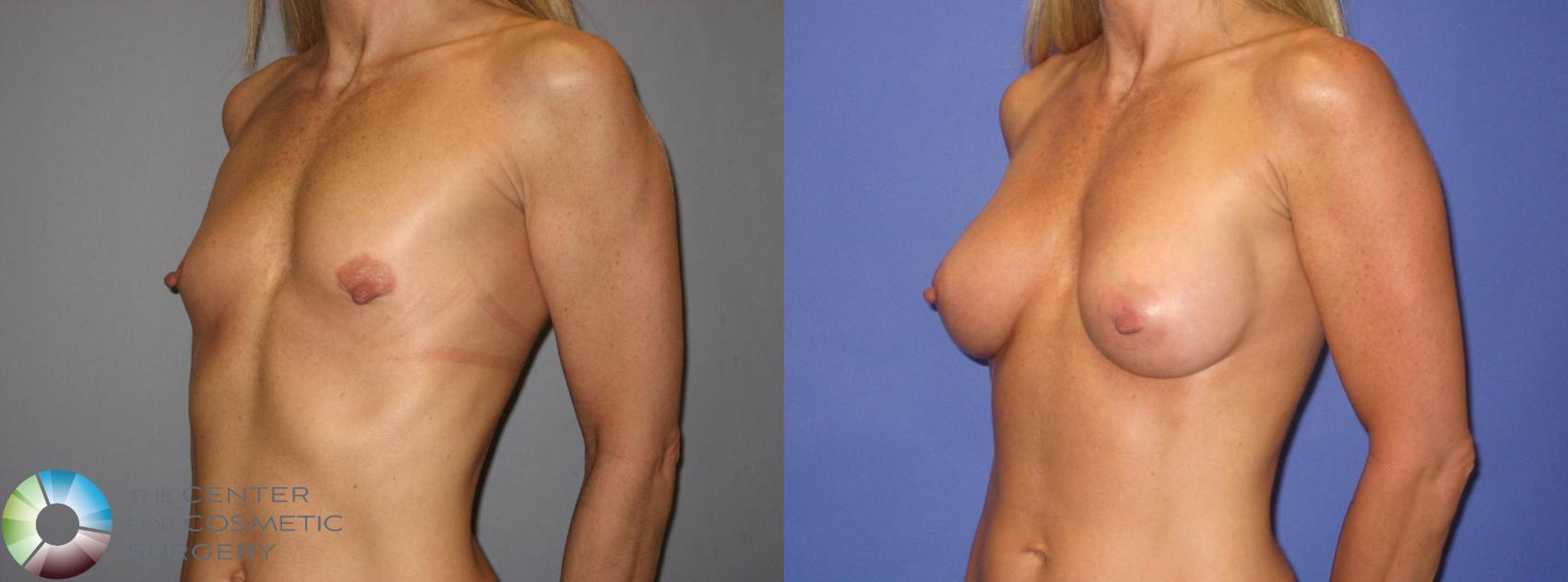 Before & After Breast Augmentation Case 242 View #2 in Denver and Colorado Springs, CO
