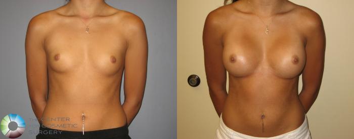 Before & After Breast Augmentation Case 245 View #1 in Denver, CO