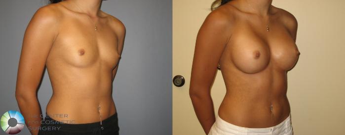 Before & After Breast Augmentation Case 245 View #2 in Denver, CO