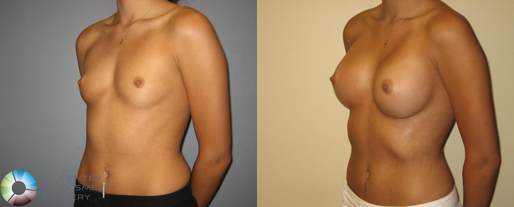 Before & After Breast Augmentation Case 245 View #3 View in Golden, CO