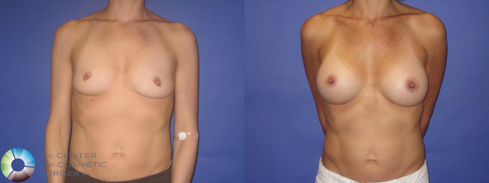 Before & After Breast Augmentation Case 246 View #1 in Denver, CO