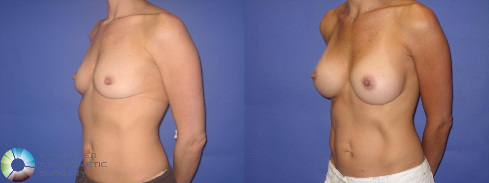Before & After Breast Augmentation Case 246 View #2 in Denver and Colorado Springs, CO
