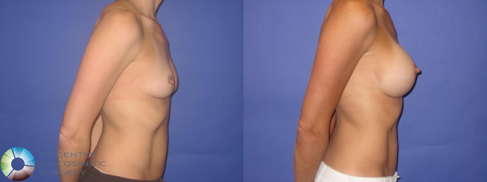 Before & After Breast Augmentation Case 246 View #3 in Denver and Colorado Springs, CO