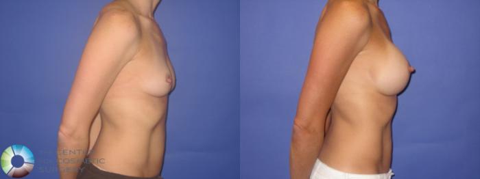 Before & After Breast Augmentation Case 246 View #3 View in Golden, CO