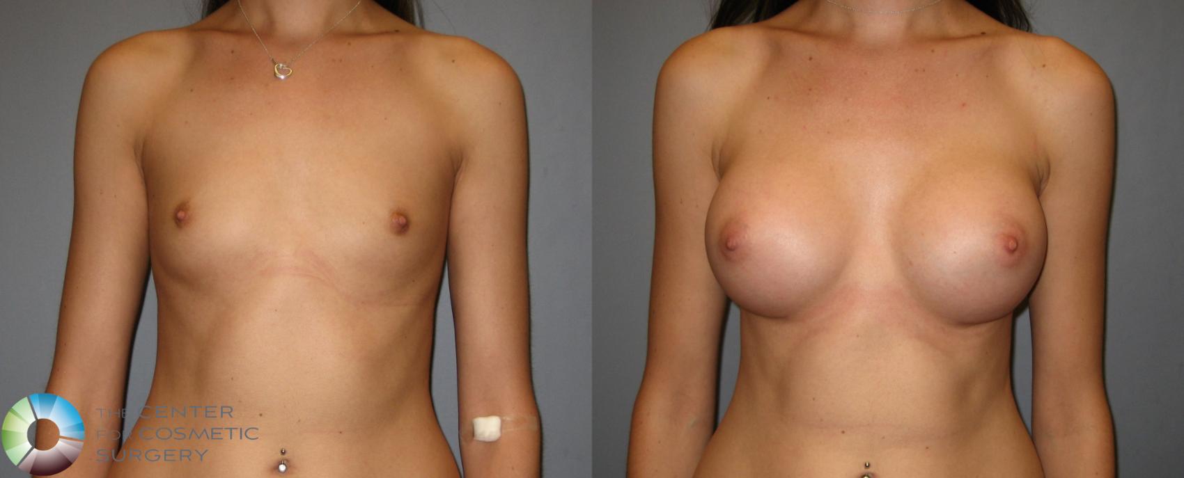 Before & After Breast Augmentation Case 247 View #2 in Denver and Colorado Springs, CO