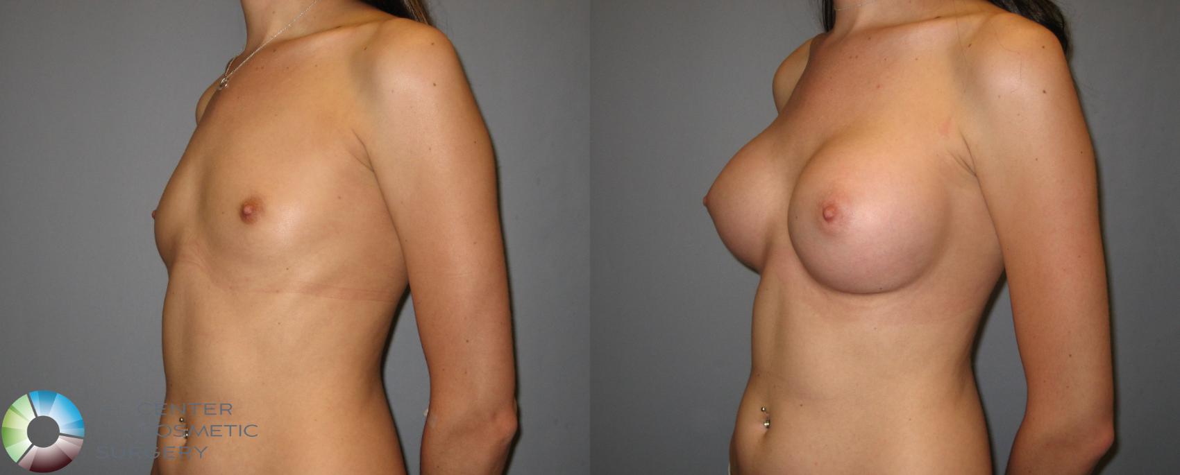 Before & After Breast Augmentation Case 247 View #3 View in Golden, CO