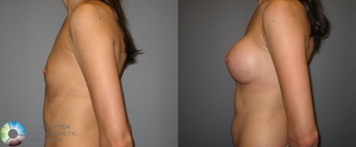 Before & After Breast Augmentation Case 247 View #4 View in Golden, CO