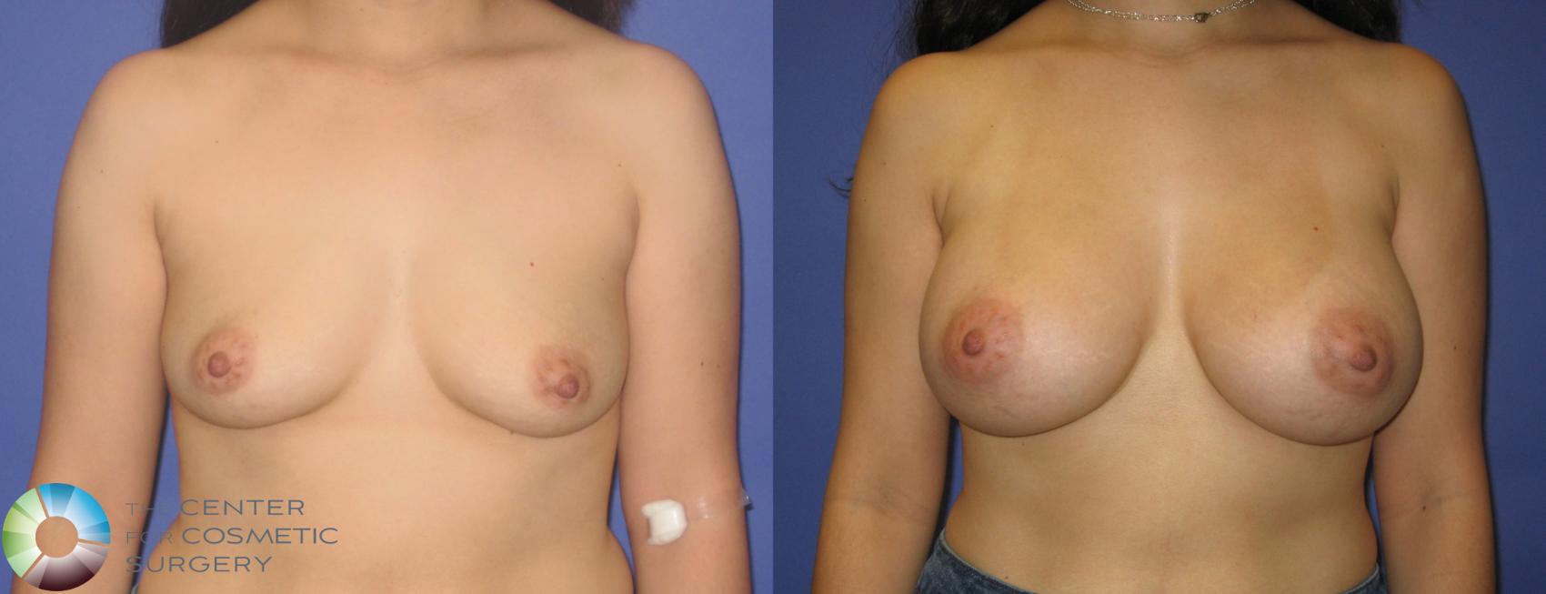 Before & After Breast Augmentation Case 273 View #1 in Denver and Colorado Springs, CO