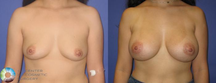 Before & After Breast Augmentation Case 273 View #1 View in Golden, CO