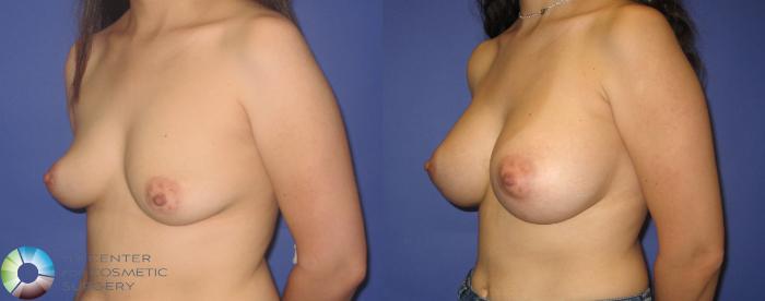 Before & After Breast Augmentation Case 273 View #2 View in Golden, CO