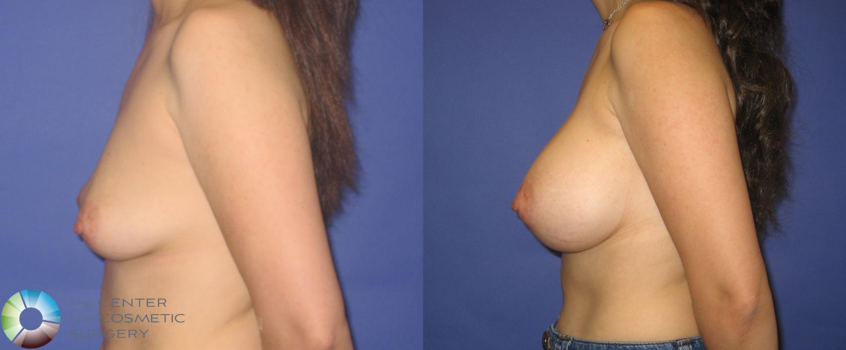 Before & After Breast Augmentation Case 273 View #3 View in Golden, CO