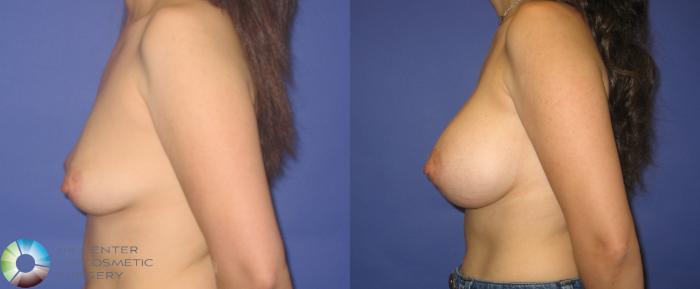 Before & After Breast Augmentation Case 273 View #3 View in Golden, CO