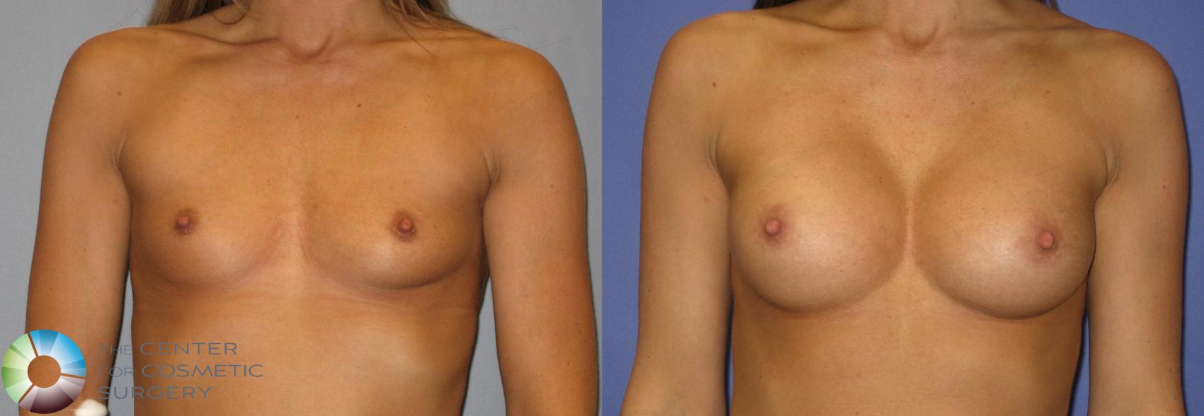 Before & After Breast Augmentation Case 274 View #1 in Denver, CO