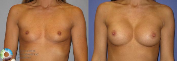 Before & After Breast Augmentation Case 274 View #1 View in Golden, CO