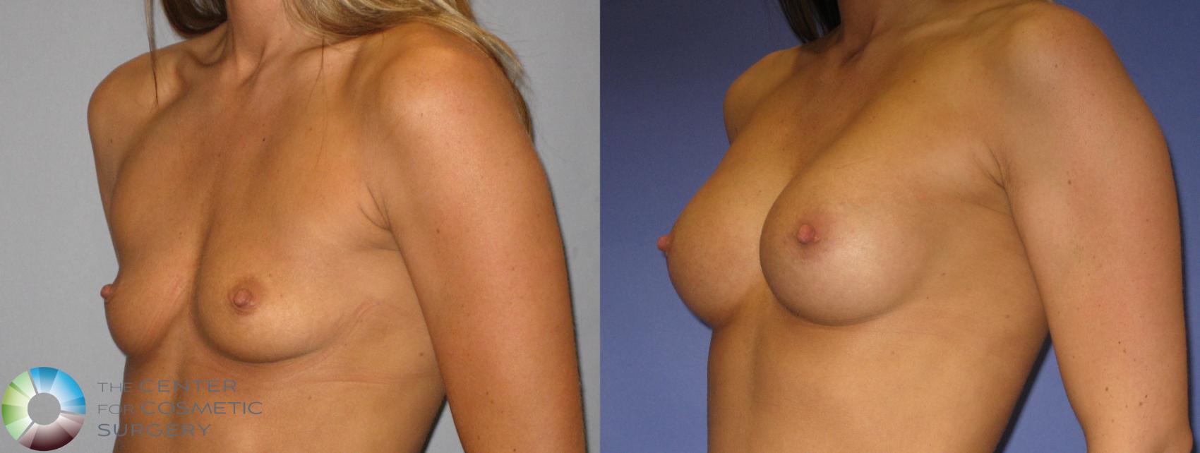 Before & After Breast Augmentation Case 274 View #2 in Denver and Colorado Springs, CO
